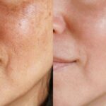 Qué pasa si me lavo la cara con agua oxigenada